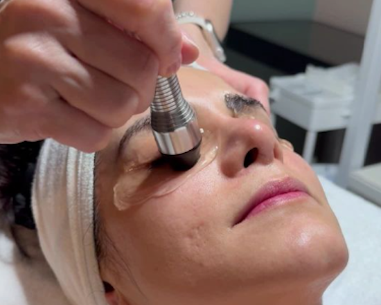 Forma-I dry eye treatment and hydration facial in North Vancouver