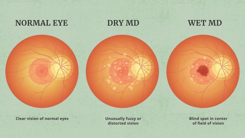 Dry AMD vs Wet AMD