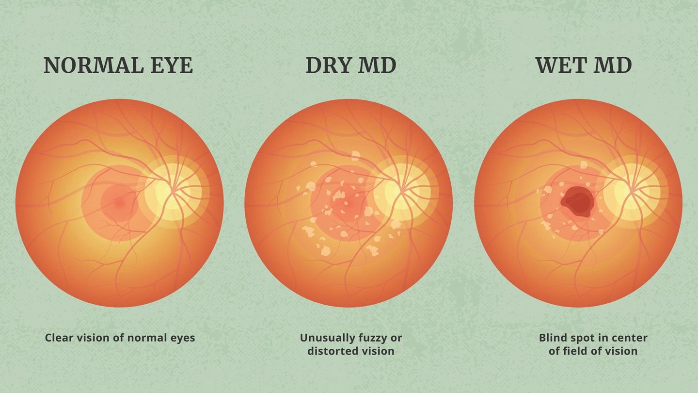 Dry AMD vs Wet AMD